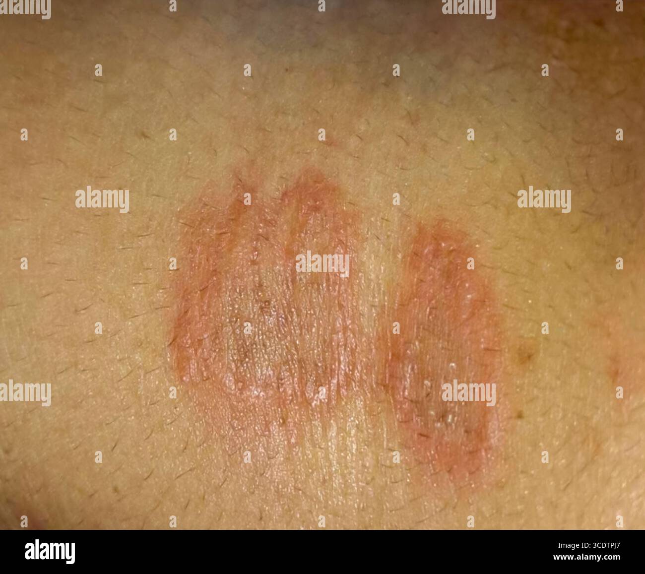 Nahaufnahme der Tinea corporis, auch bekannt als Ringelflechte, einer häufigen Pilzinfektion der Haut, die durch einen roten, kreisförmigen und schuppigen Hautausschlag gekennzeichnet ist. Stockfoto