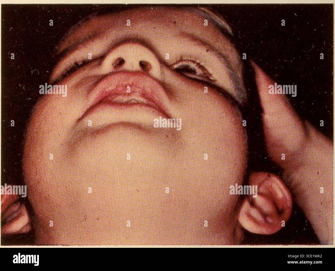 Nevoides Basalzellkarzinom-Syndrom 3. Stockfoto