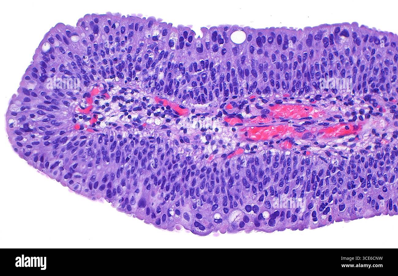 Lichtmikrographie des Urothelpapilloms. Ein urotheliales Papillom ist ein gutartiges Wachstum, das im Harntrakt auftritt. Das Papillom besteht aus dünnen Papillen oder fingerähnlichen Strukturen, von denen eine in diesem Bild zu sehen ist. Die Papille hat einen fibrovaskulären Kern mit Blutgefäßen (weiß mit hellroten Streifen) und ist von gutartigen Urothelzellen (violett) gesäumt. Die Urothelzellauskleidung des urothelialen Papilloms ist identisch mit der des normalen Urothels. Hämatoxylin- und Eosin-gefärbter Gewebeschnitt. Vergrößerung: 200-fach bei 10 cm Druck. Stockfoto