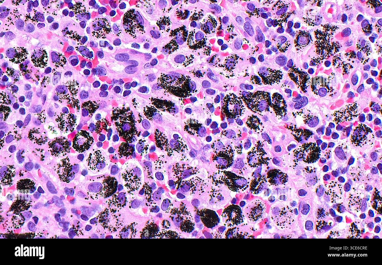 Anthrakotisches Pigment im Lungenlymphknoten, Lichtmikrograph Stockfoto