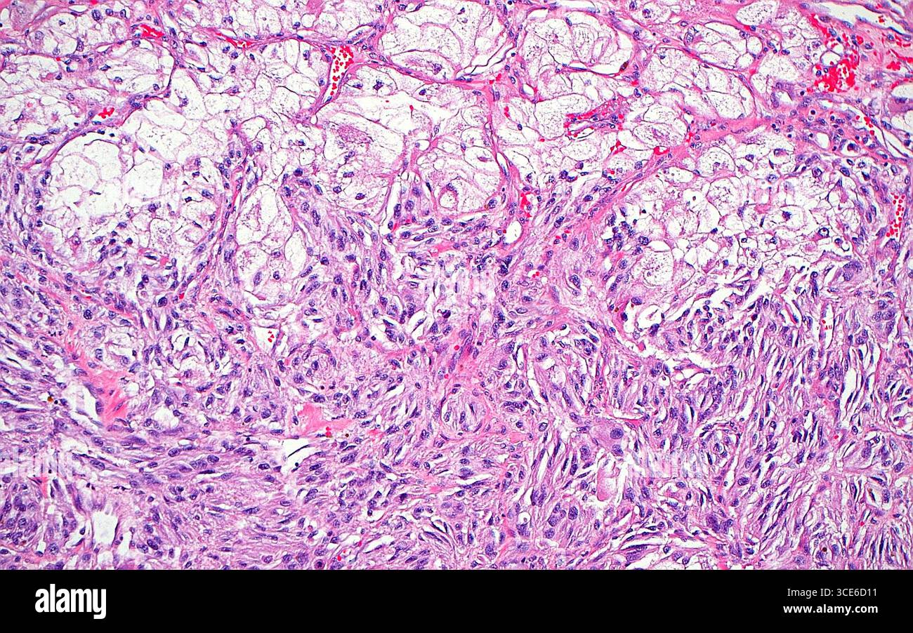 Sarkomatoidveränderung beim Nierenkarzinom, Lichtmikrograph Stockfoto