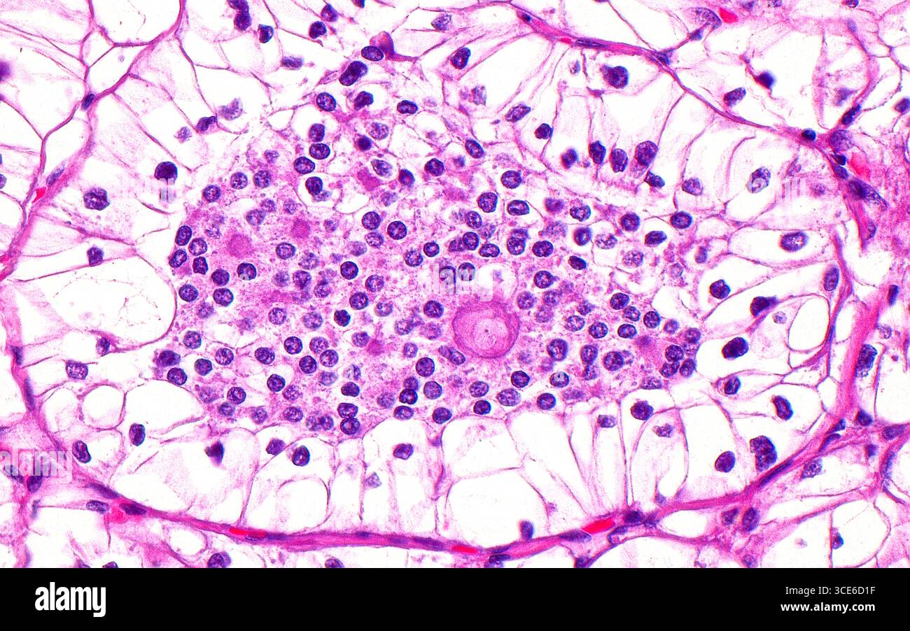Lichtmikroskop des Translokations-t(6,11)-Nierenzellkarzinoms. Diese Art von Nierenkrebs weist eine charakteristische Translokation zwischen den Chromosomen 6 und 11 auf. Histologisch zeigt diese Art von Nierenkrebs zwei Zellpopulationen: Größere Zellen mit klarem Zytoplasma (Peripherie des Bildes), die um kleinere Zellen angeordnet sind (Bildmitte). Die kleineren Zellen befinden sich auch zwischen Knoten aus hyalinem Material (runde Tintenstrukturen), ein weiteres charakteristisches morphologisches Merkmal. Hämatoxylin- und Eosin-gefärbter Gewebeschnitt. Vergrößerung: 400-fach bei 10 cm Druck. Stockfoto Lichtmikroskop des Translokations-t(6,11)-Nierenzellkarzinoms. Diese Art von Nierenkrebs weist eine charakteristische Translokation zwischen den Chromosomen 6 und 11 auf. Histologisch zeigt diese Art von Nierenkrebs zwei Zellpopulationen: Größere Zellen mit klarem Zytoplasma (Peripherie des Bildes), die um kleinere Zellen angeordnet sind (Bildmitte). Die kleineren Zellen befinden sich auch zwischen Knoten aus hyalinem Material (runde Tintenstrukturen), ein weiteres charakteristisches morphologisches Merkmal. Hämatoxylin- und Eosin-gefärbter Gewebeschnitt. Vergrößerung: 400-fach bei 10 cm Druck. Stockfoto
