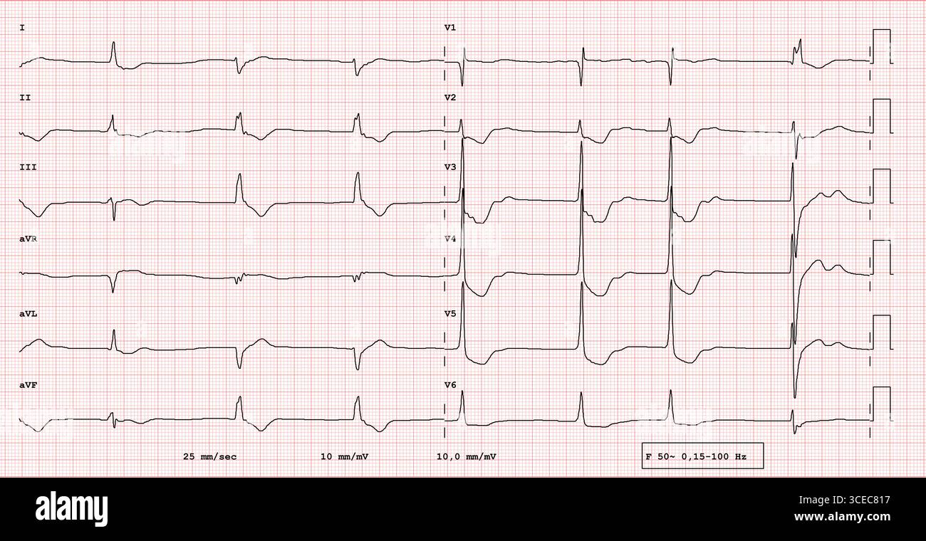 EKG-Elektrokardiogramm mit digitalem Intoxikationsmuster mit charakteristischer ST-Segment-Senkung und abfallendem Effekt bei der medizinischen 12-Kanal-Diagnose Stockfoto