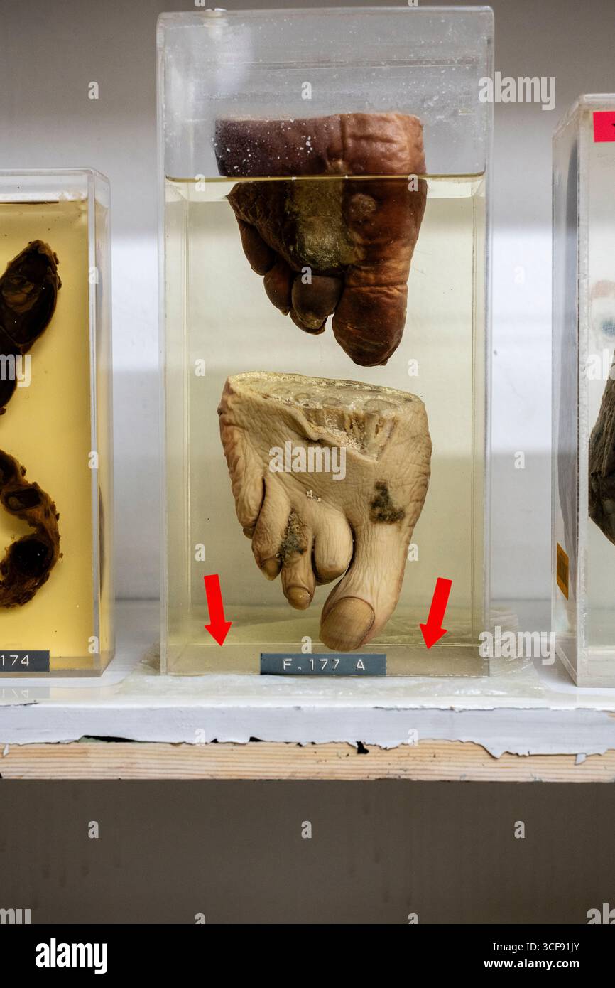 Exemplare auf dem Regal im St Barts Hospital London, Pathologiemuseum Saint Bartholomews. UK Stockfoto