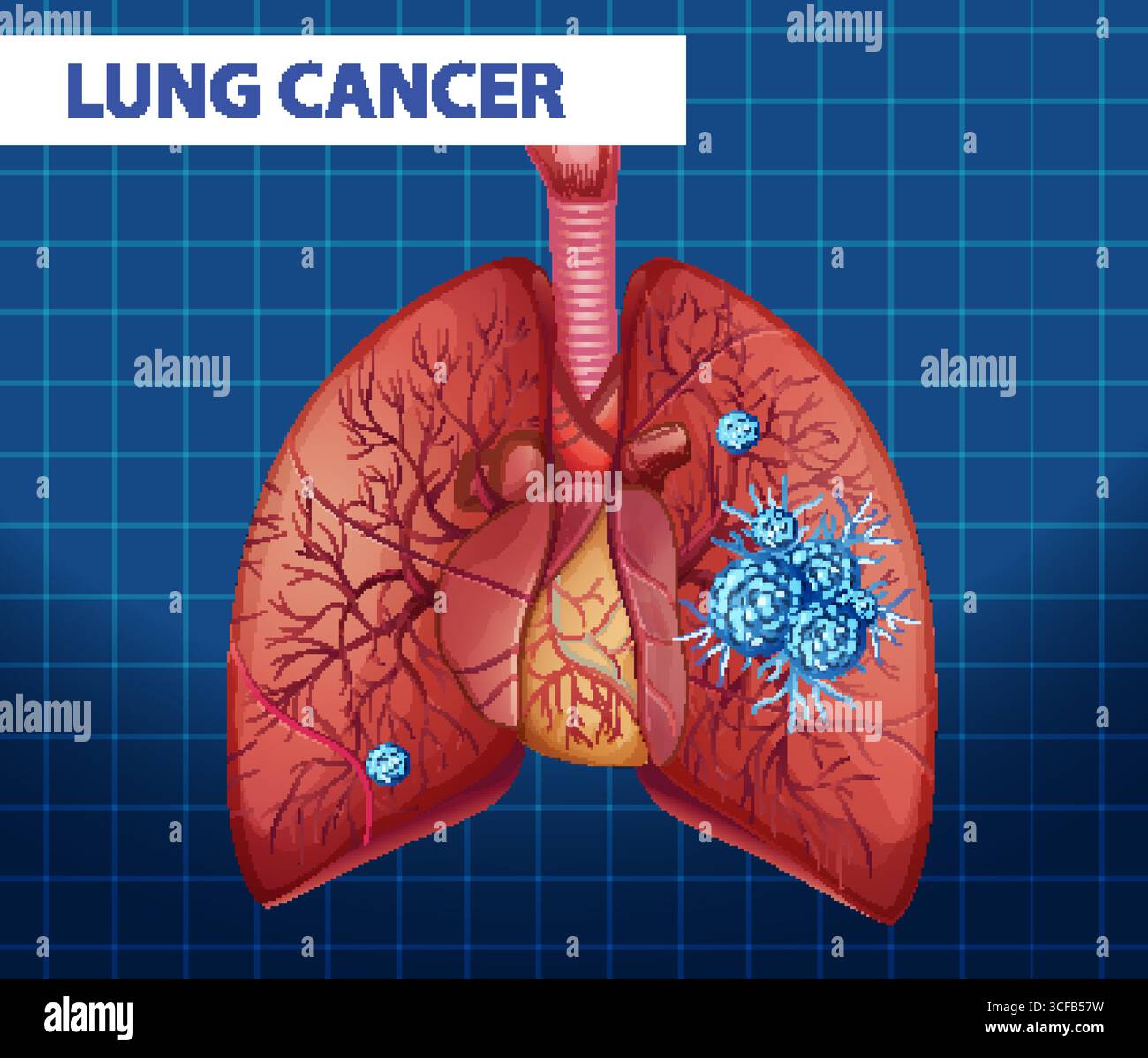 Illustration menschlicher Lungen mit Krebszellen, mit detaillierter Anatomie und lebendigen Farben vor einem Gitterhintergrund Stock Vektor