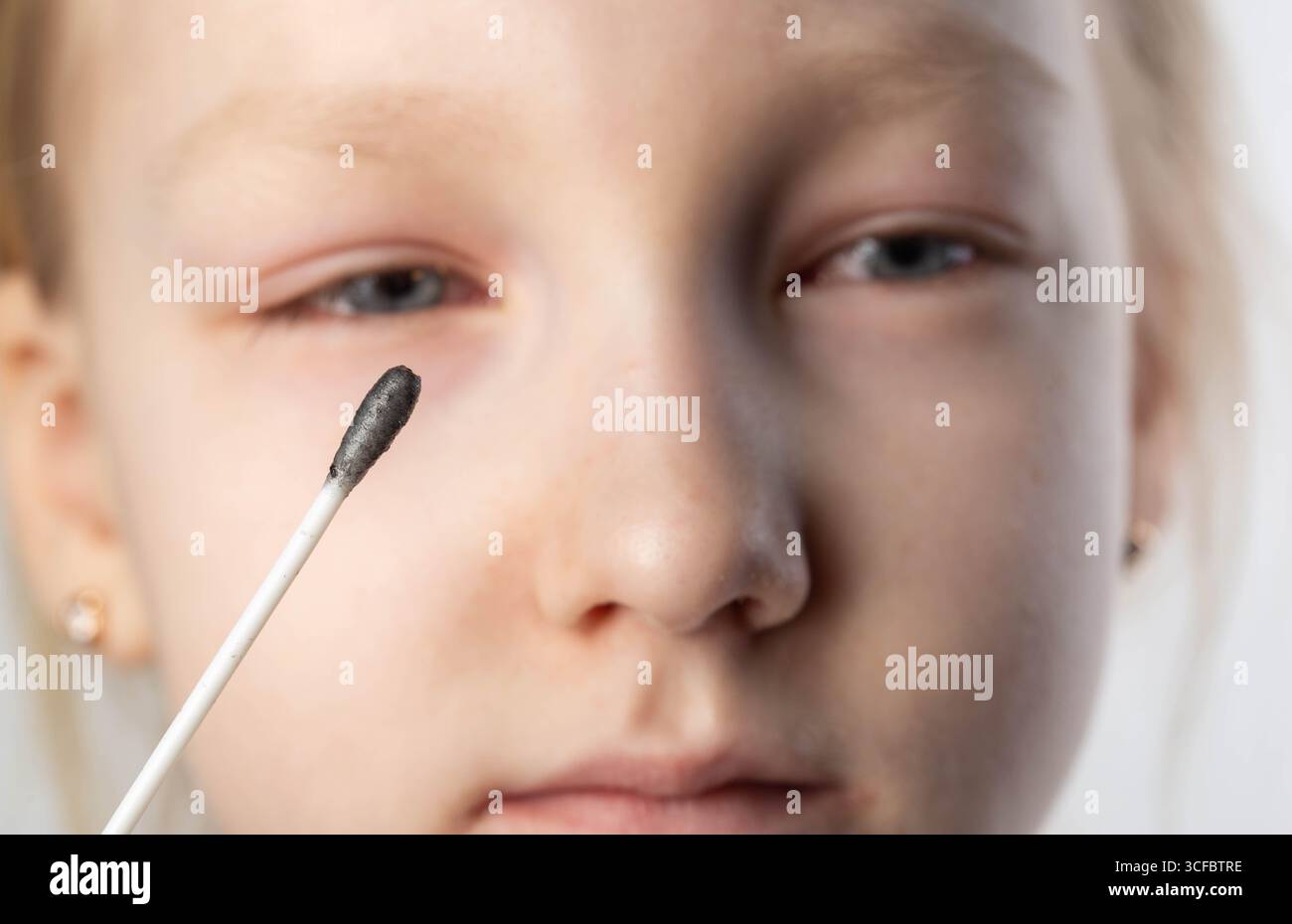 Ein Augentupfer gegen Infektionen und Bakterien bei einem Mädchen mit Bindehautentzündung. Bestimmung des Infektionserregers. Stockfoto