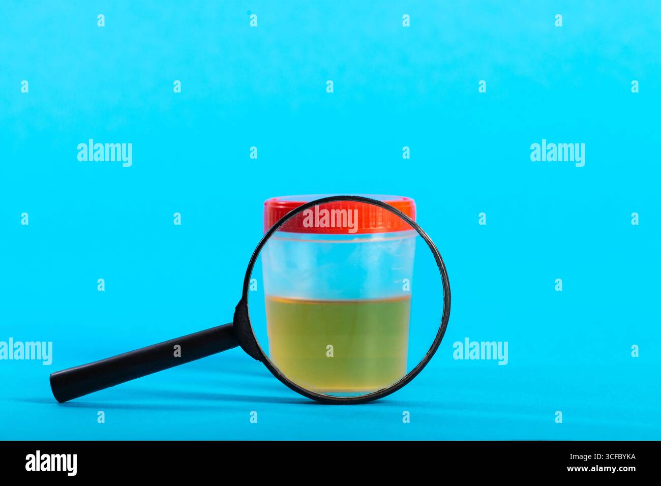 Urinanalyse unter einer Lupe auf blauem Hintergrund. Konzept der Urinprüfung auf Infektionen und Leukozyten in der Urologie. Stockfoto