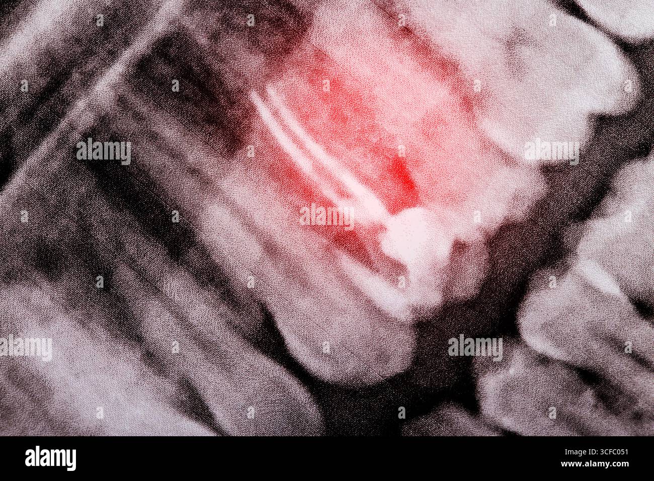 Rot entzündete Zahnfüllung im Kanal eines Pulpitis-Zahnes auf einem Röntgenbild Stockfoto