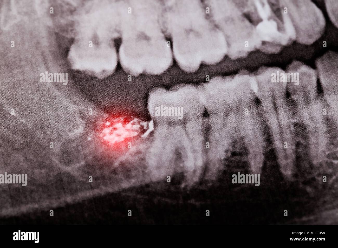 Rot entzündete Zahnpfanne mit Medizin nach Weisheitszahnentfernung auf Röntgenbildern. Komplikation der Zahnhöhle, Alveolitis. Stockfoto