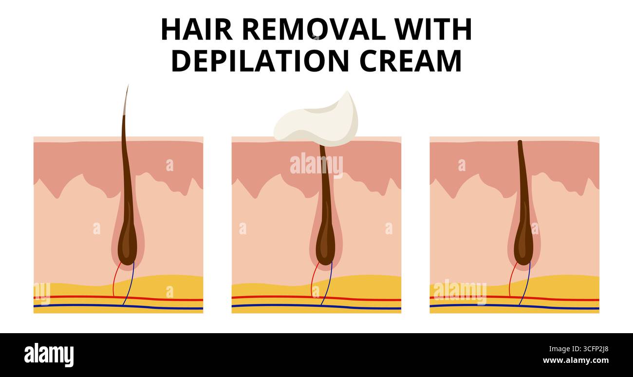 Das Auftragen der Enthaarungscreme auf die Haut löst das Haar an der Oberfläche auf, während ein Querschnitt den komplizierten Prozess der Haarentfernung offenbart und unterstreicht Stock Vektor Das Auftragen der Enthaarungscreme auf die Haut löst das Haar an der Oberfläche auf, während ein Querschnitt den komplizierten Prozess der Haarentfernung offenbart und unterstreicht Stock Vektor