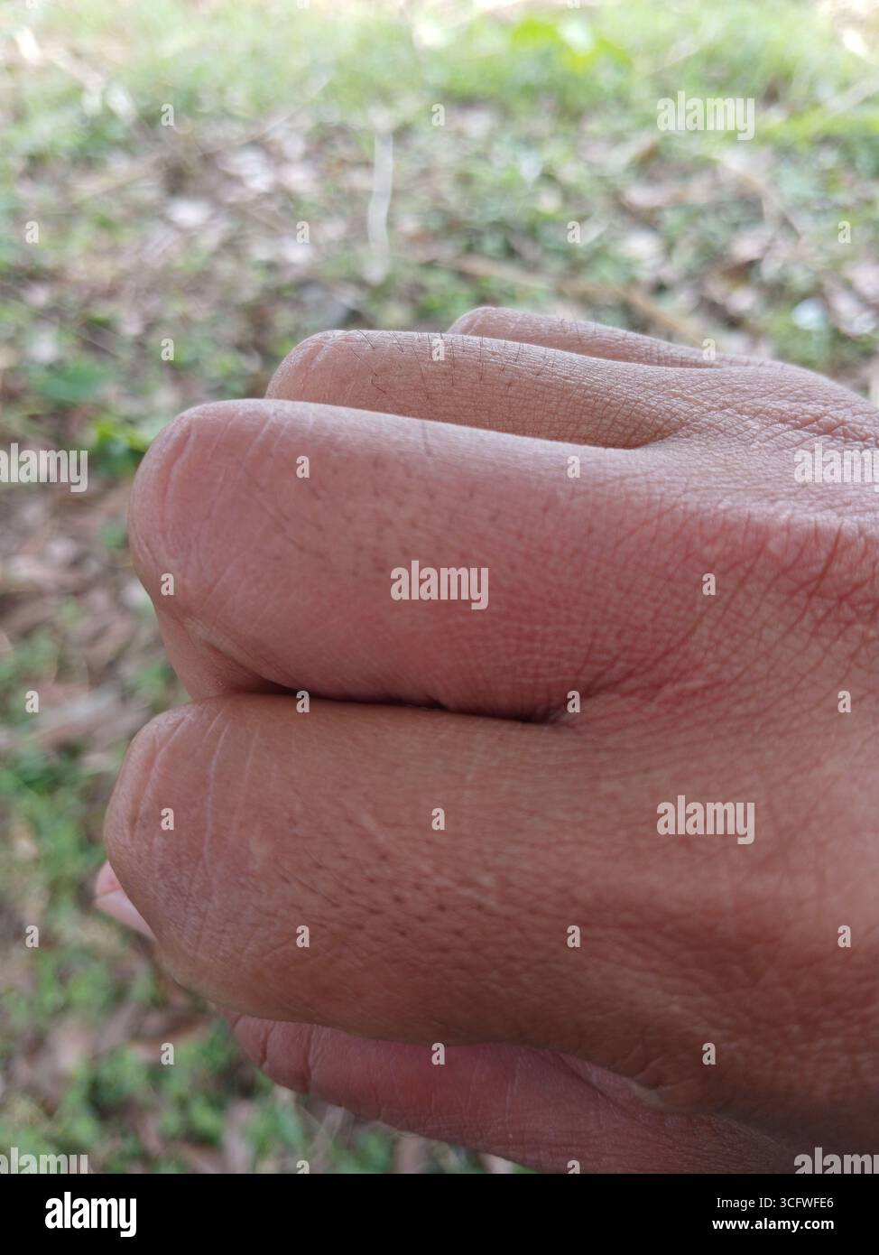 Gebräunte Haut Hand, weil sie von einer Waldbiene gestochen wurde. Stockfoto