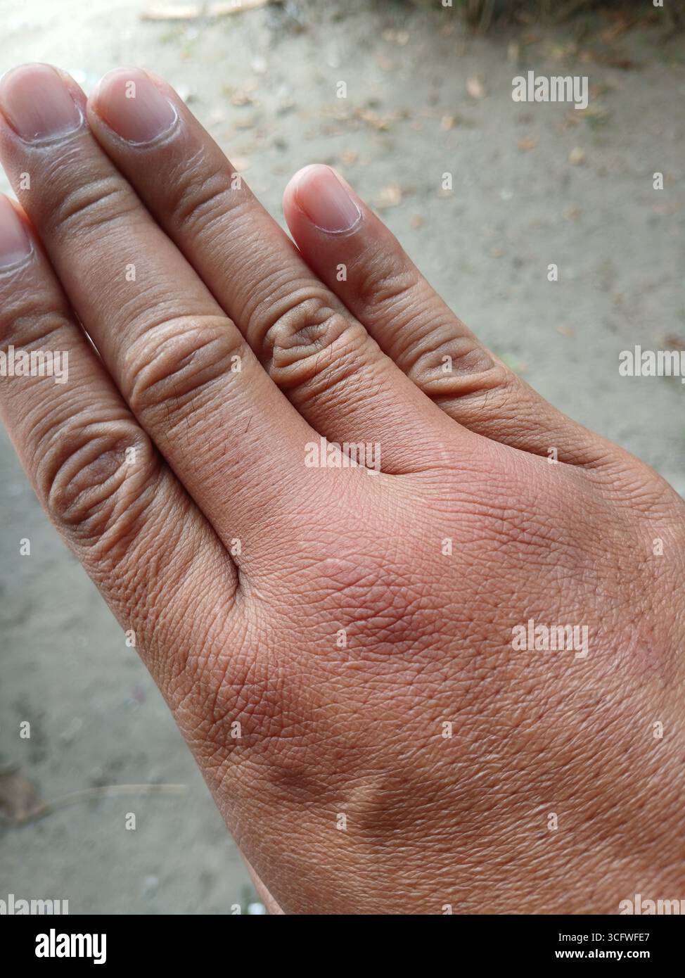 Gebräunte Haut Hand, weil sie von einer Waldbiene gestochen wurde. Stockfoto