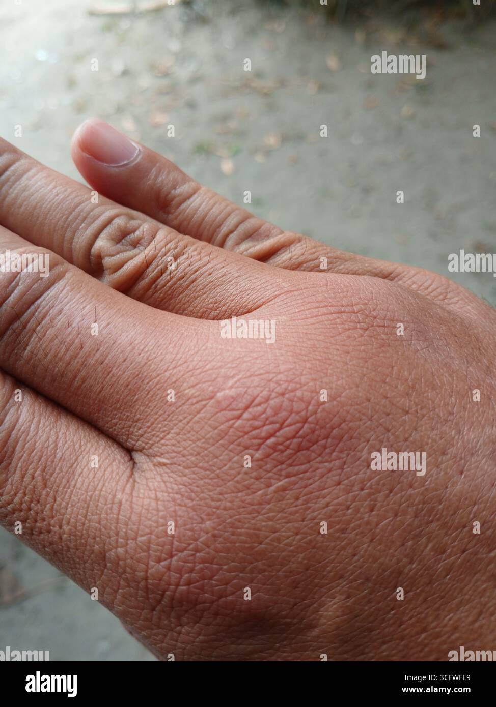 Gebräunte Haut Hand, weil sie von einer Waldbiene gestochen wurde. Stockfoto