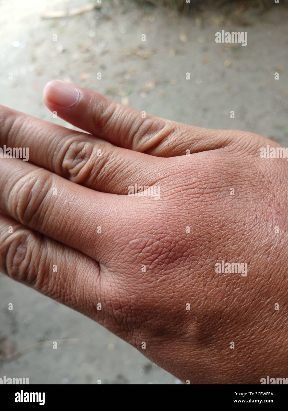 Gebräunte Haut Hand, weil sie von einer Waldbiene gestochen wurde. Stockfoto