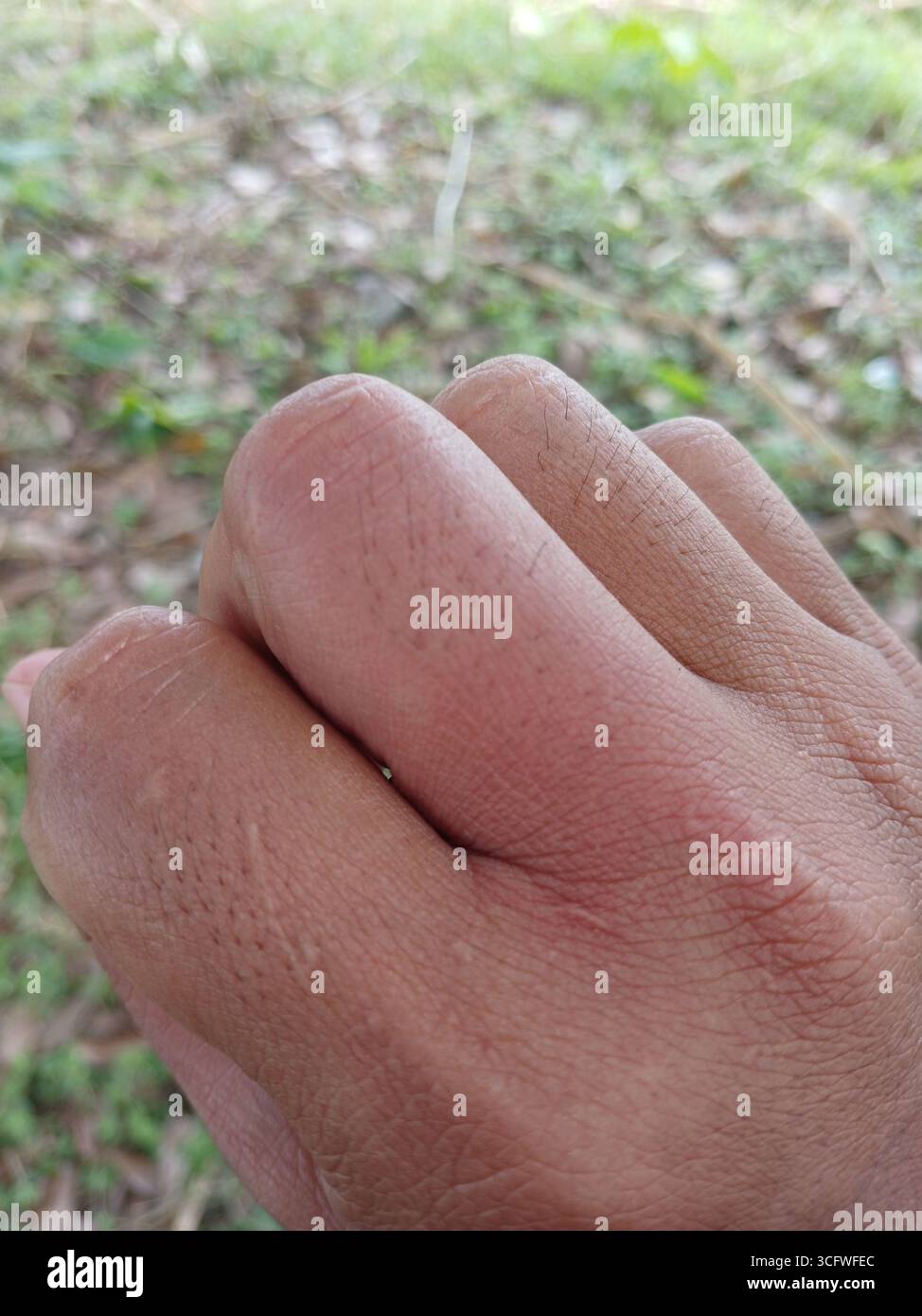 Gebräunte Haut Hand, weil sie von einer Waldbiene gestochen wurde. Stockfoto