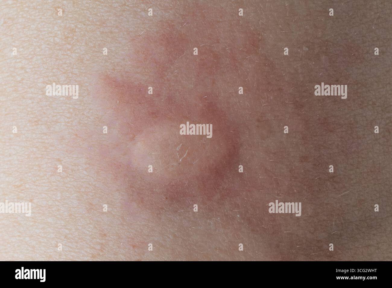 Nahaufnahme der Ringelwurmpilzinfektion, die einen rötlichen kreisförmigen Ausschlag auf der menschlichen Haut verursacht und Hautgesundheit hervorhebt Stockfoto