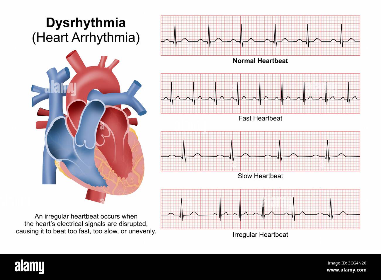 Dysrhythmie - Herz-Arrhythmie Medizinische Flashcard Illustration Stockfoto