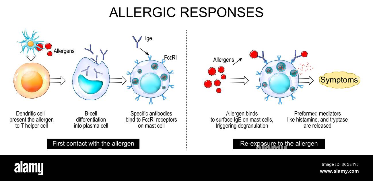 Allergie. Erster Kontakt mit dem Allergen und erneute Exposition mit dem Allergen. Aufbau der Mastzelle. Die Rolle von Histamin, Allergenen, Immunglobulin IgE in allen Stock Vektor