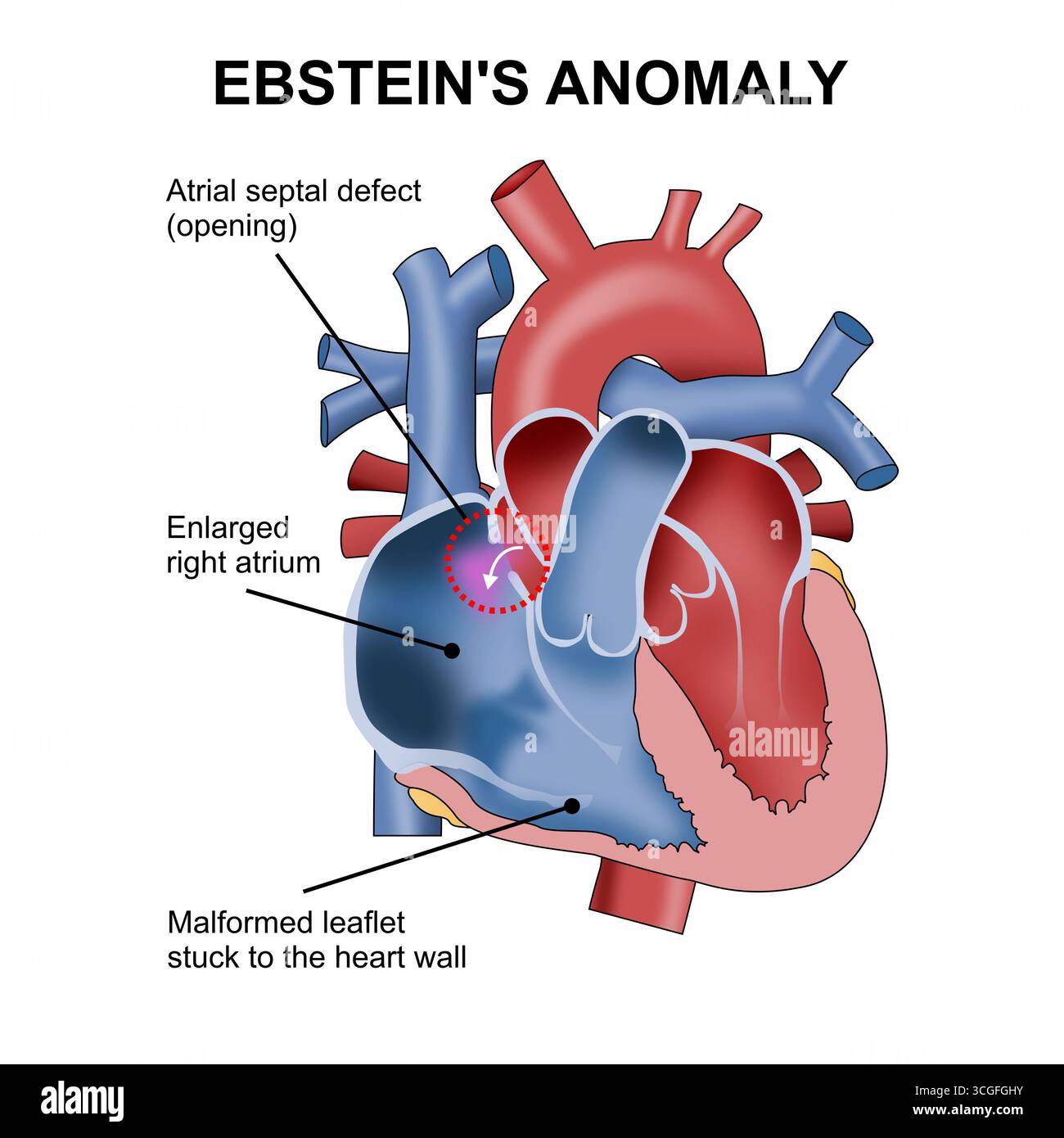 Ebsteins-Anomalie-Flashcard-Herz-Illustration Stockfoto