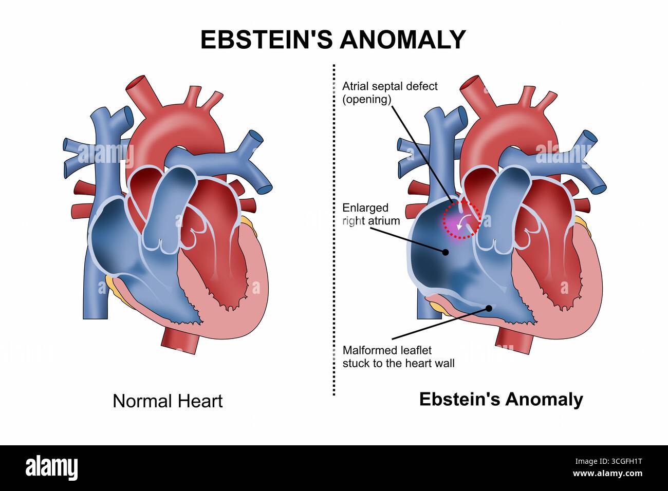 Ebsteins-Anomalie-Flashcard-Herz-Illustration Stockfoto