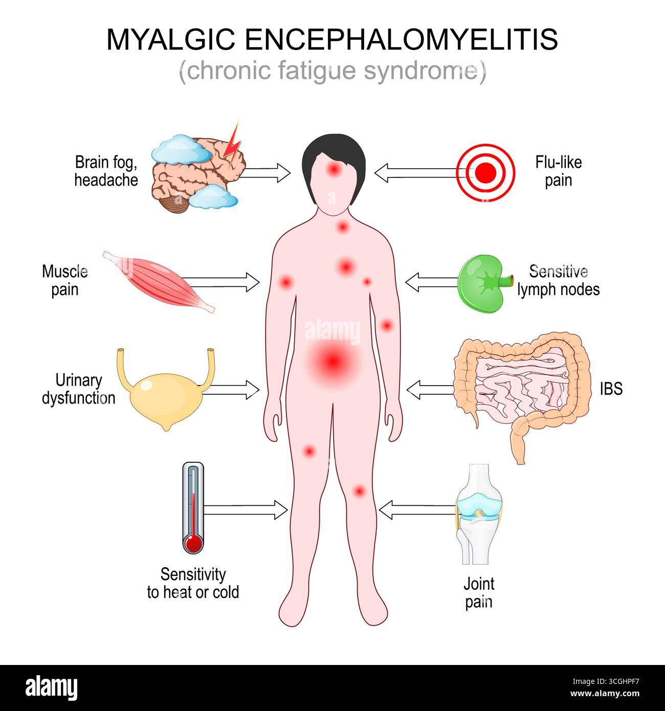 Symptome der myalgischen Enzephalomyelitis. Das Chronische Müdigkeitssyndrom. Detailliertes Vektorposter Stock Vektor