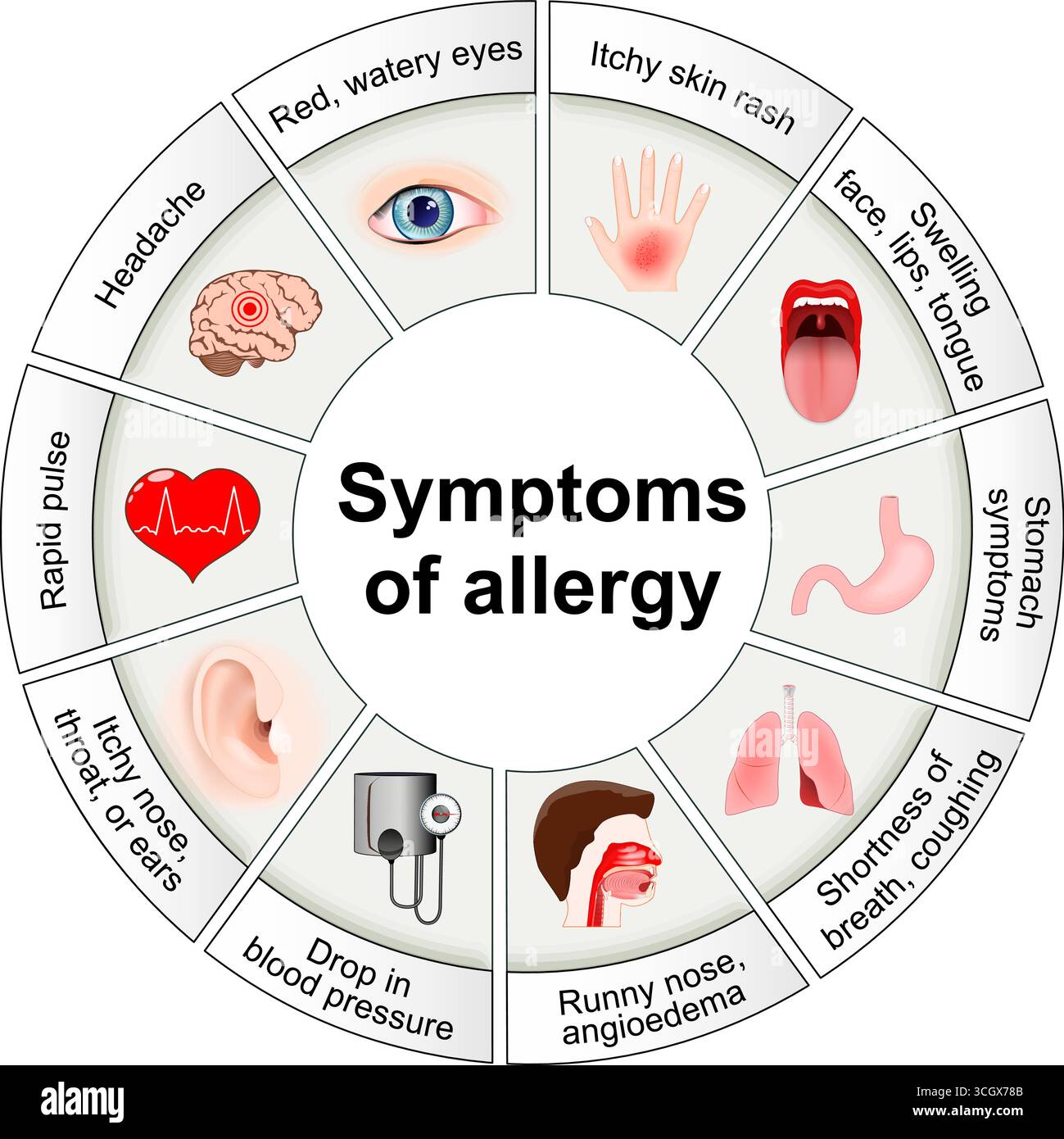 Symptome der Allergie. Histamin und lokale Immunantworten. Detailliertes Vektorposter Stock Vektor