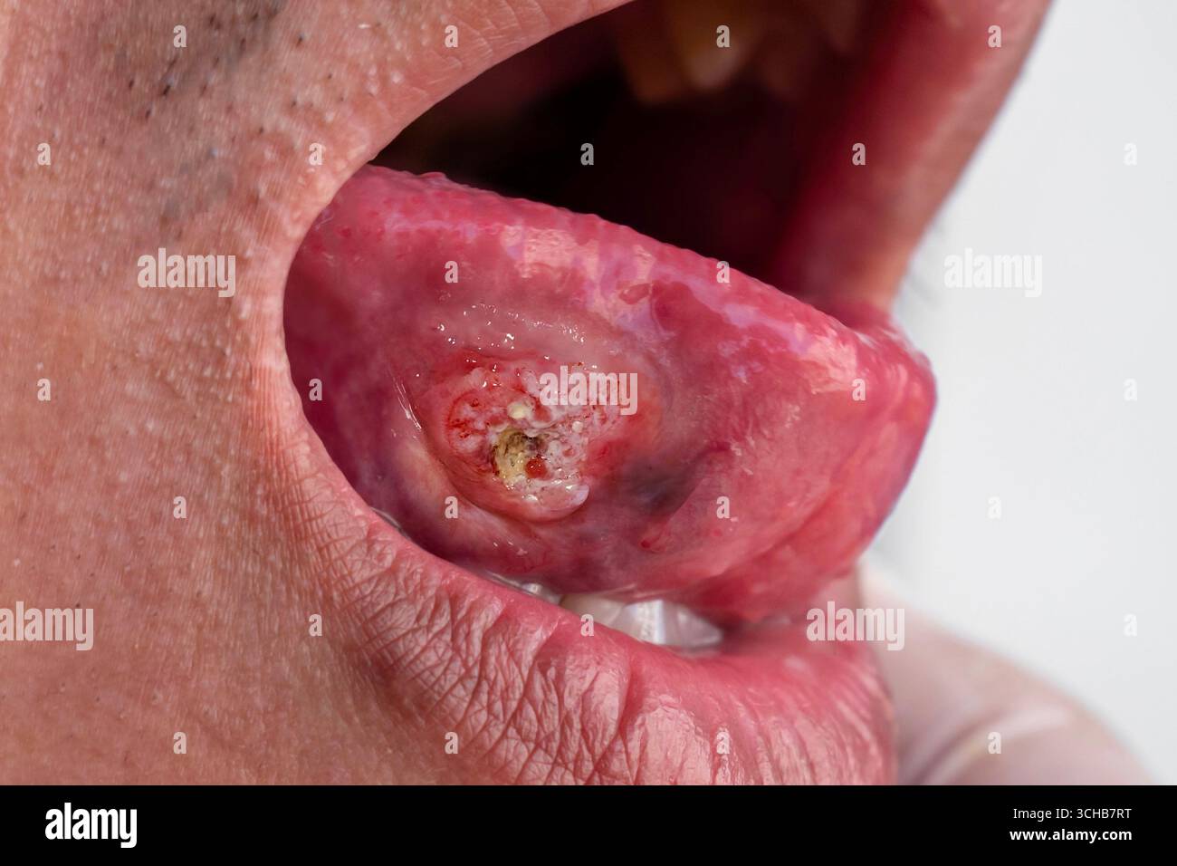 Plattenepithelkarzinom einer Zunge. Mundkrebs oder bösartiger Tumor eines asiatischen, burmesischen männlichen Patienten. Stockfoto