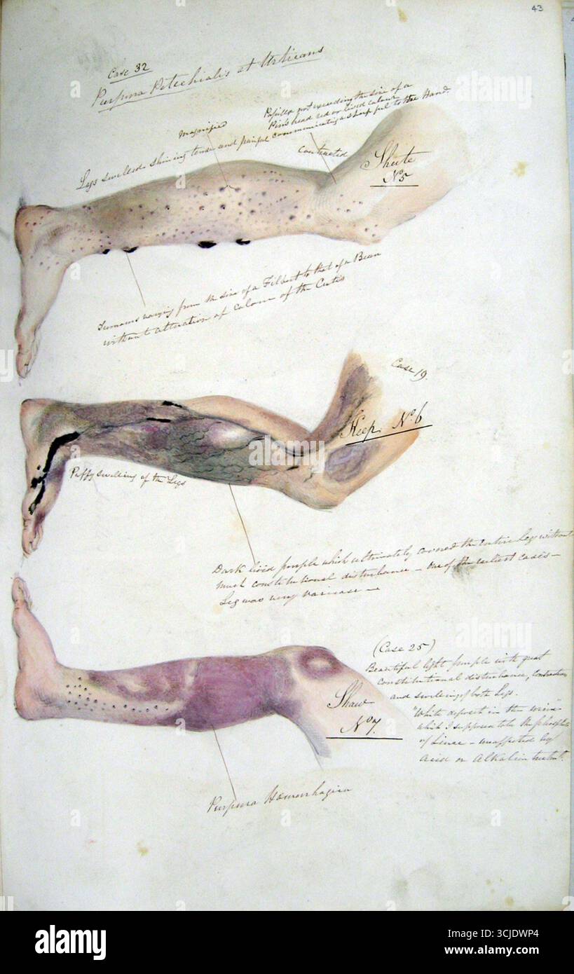 Historische medizinische Illustration aus der Zeitschrift von Henry Walsh Mahon, die Fälle von Skorbut an Bord des HM Sträfling Ship Barrosa, Februar 1841 darstellt. Die Seite zeigt detaillierte Zeichnungen von Beinen, die von Purpura, Petechien und Blutungen betroffen sind, mit handschriftlichen medizinischen Notizen, die Schwellungen, Verfärbungen und Gefäßschäden beschreiben, die durch Vitamin-C-Mangel verursacht werden. Stockfoto