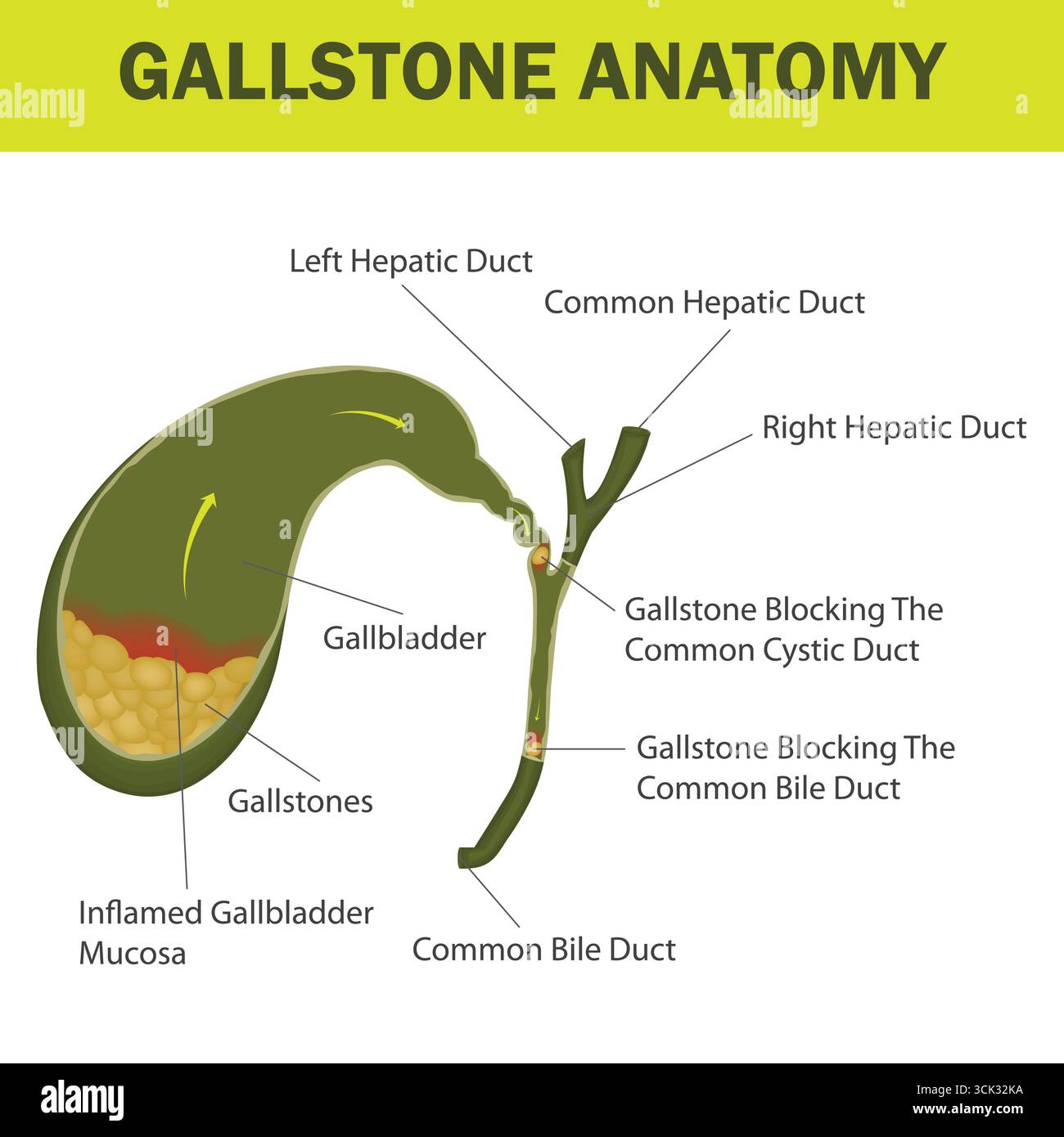 Medizinische Illustration der Gallensteinanatomie, die Gallenblase, Gallenwege und Gallensteinblockaden mit markierten Teilen zeigt. Stock Vektor