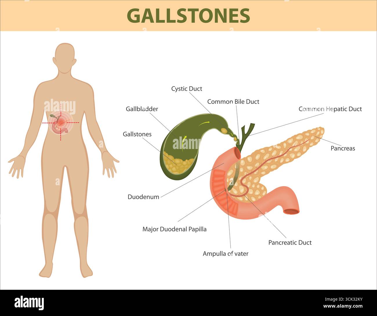 Medizinische Darstellung der Gallensteine in der Gallenblase und ihre anatomische Beziehung zu Leber, Pankreas, Gängen und Zwölffingerdarm. Stock Vektor