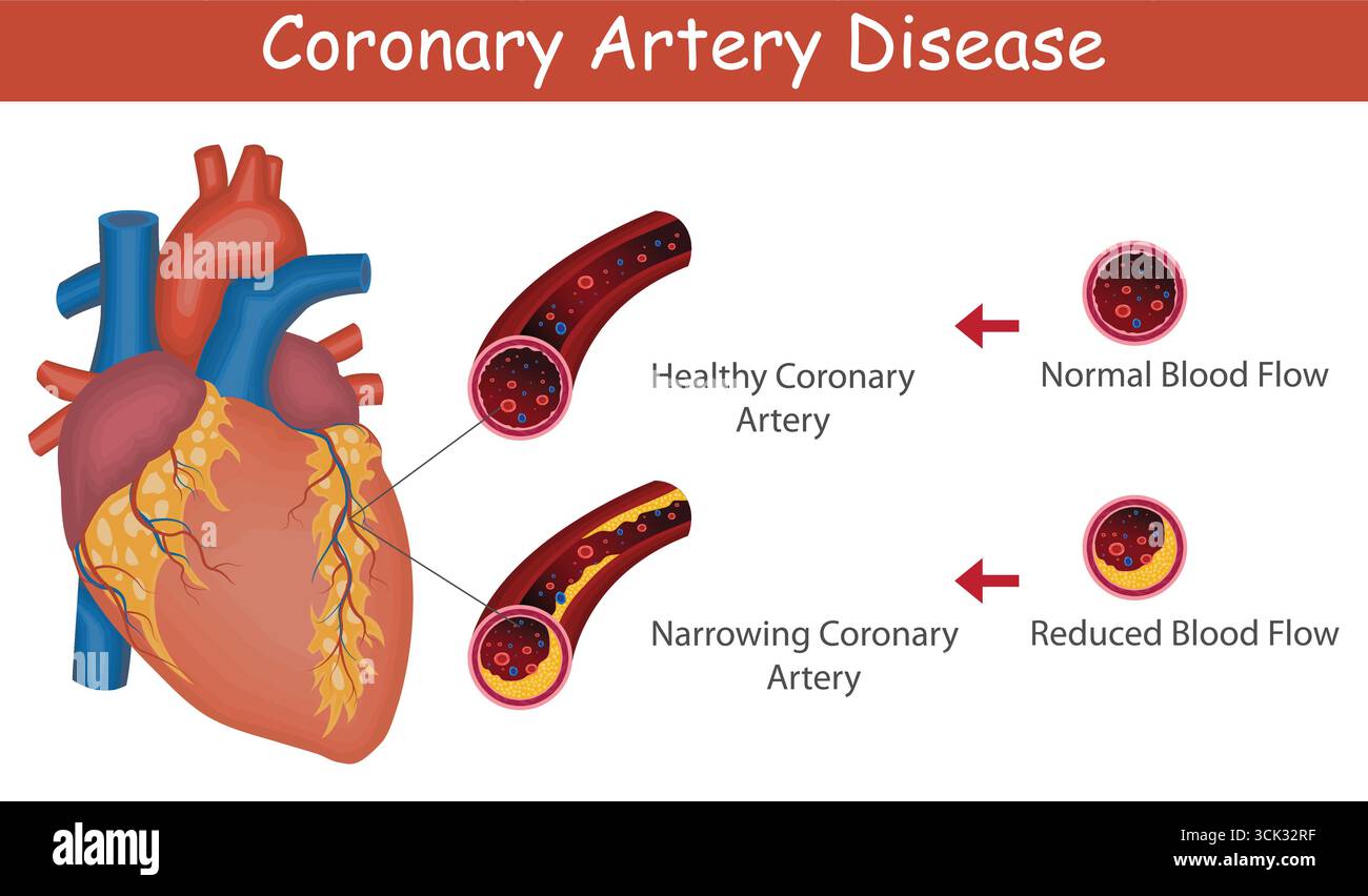 Medizinische Illustration des Fortschreitens der koronaren Herzkrankheit mit Herzanatomie und Arterienverblockungsstadien. Progressionsdiagramm Der Koronaren Herzkrankheit. Stock Vektor