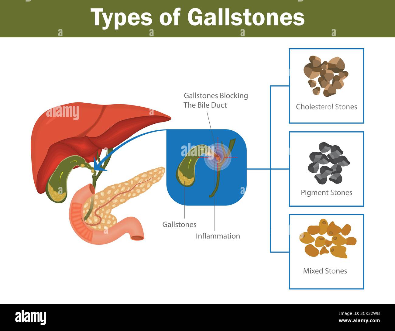Arten von Gallensteinen medizinisches Diagramm mit Cholesterinsteinen, Pigmentsteinen, Mischsteinen und Gallensteinblockade im Gallengang. Stock Vektor