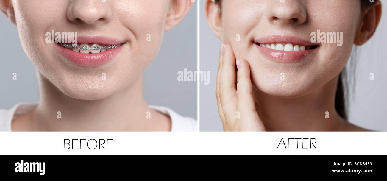 Frau, die Zähne zeigt, während und nach der Verwendung von Zahnspangen, Nahaufnahme. Collage von Fotos auf grauem Hintergrund Stockfoto