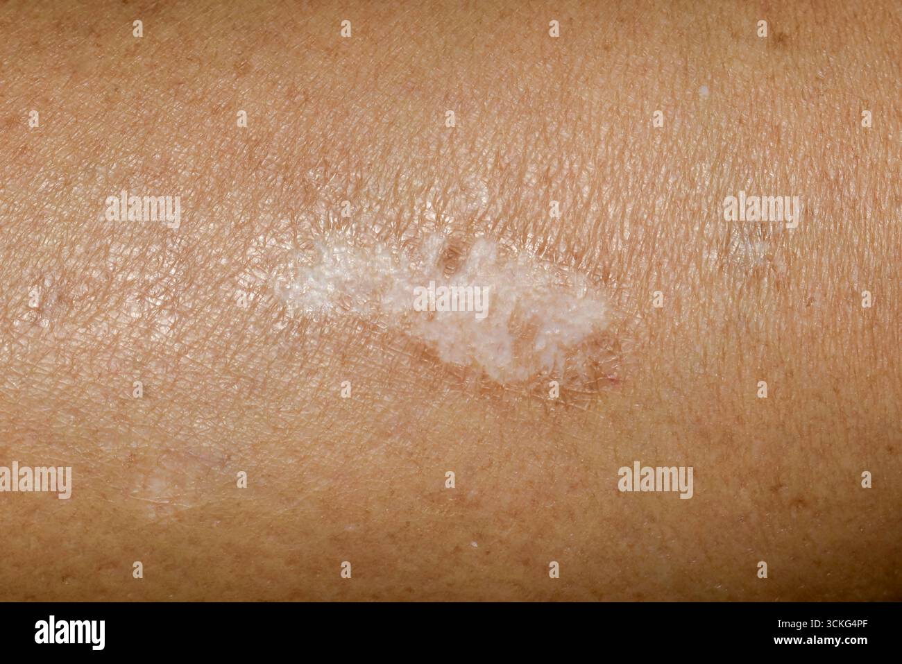 Nahaufnahme einer gut geheilten, blasshypertrophen Narbe am Unterarm einer Person. Stockfoto