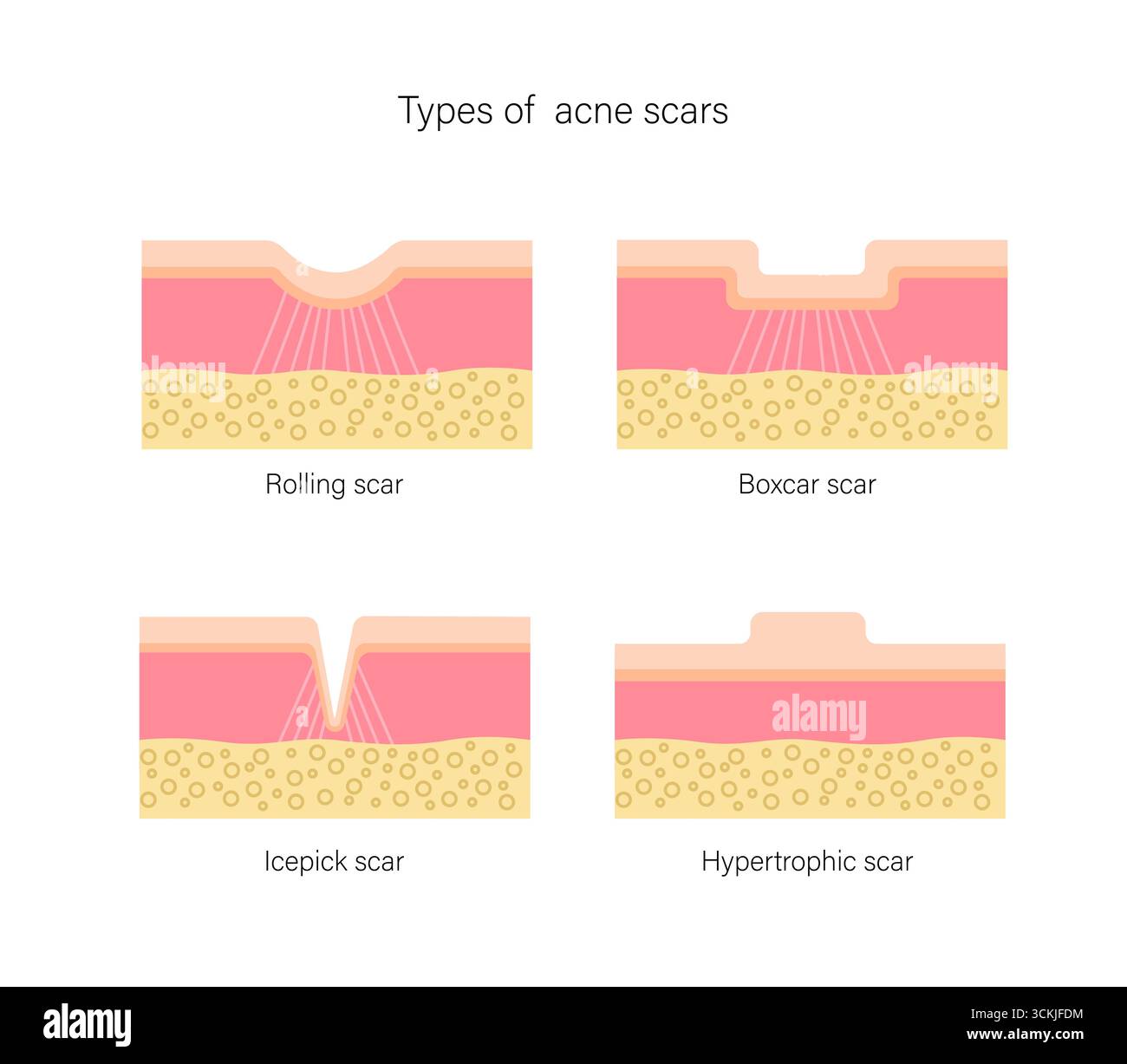 Set von Aknennarbenarten, atrophisch und hypertrophisch, rollend, Boxcar, Eispickel. Medizinische geometrische flache Illustration. Stock Vektor