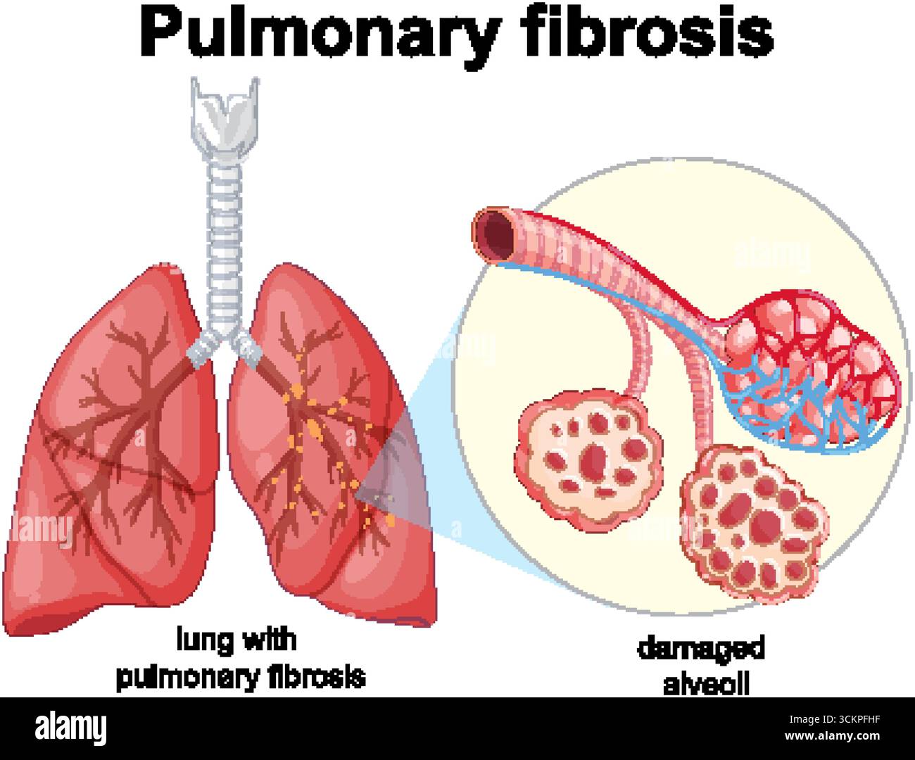 Detailliertes Vektordiagramm von Lungen mit Lungenfibrose und Nahaufnahme geschädigter Alveolstruktur Stock Vektor