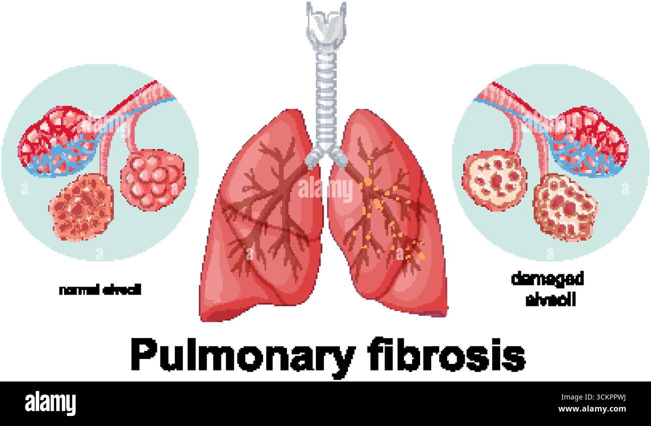 Vektor-Illustration zeigt gesunde versus beschädigte Alveolen in der Lunge und hebt die Auswirkungen der Lungenfibrose hervor Stock Vektor