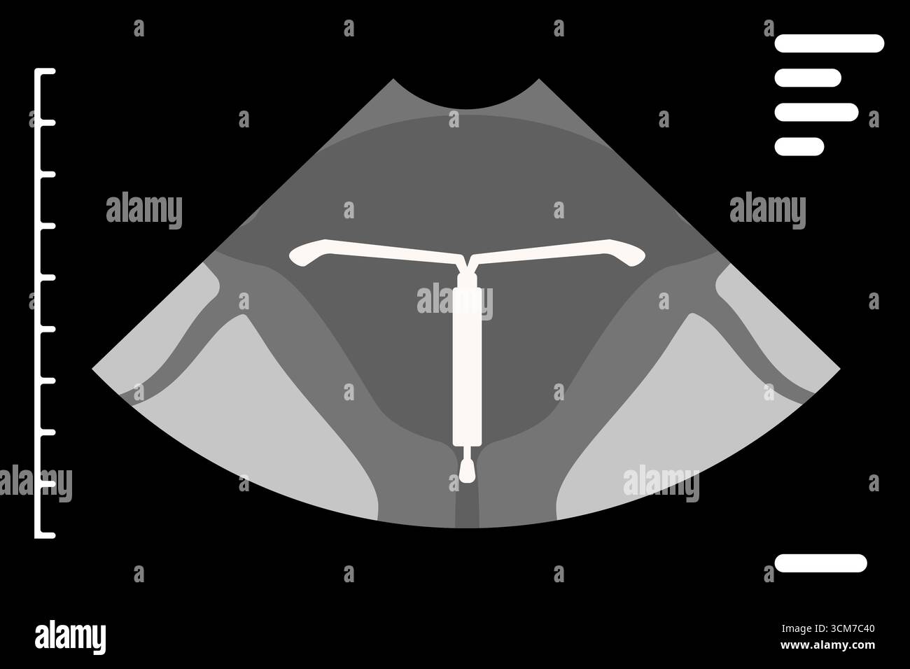 Ultraschall mit intrauterinem Gerät im Uterus Stock Vektor