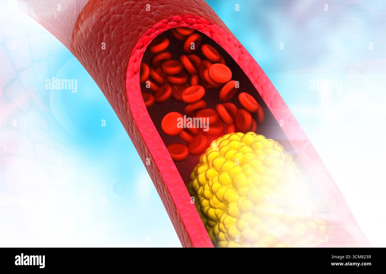 Verstopfte Arterien, Cholesterinplaque in der Arterie. 3D-Abbildung Stockfoto