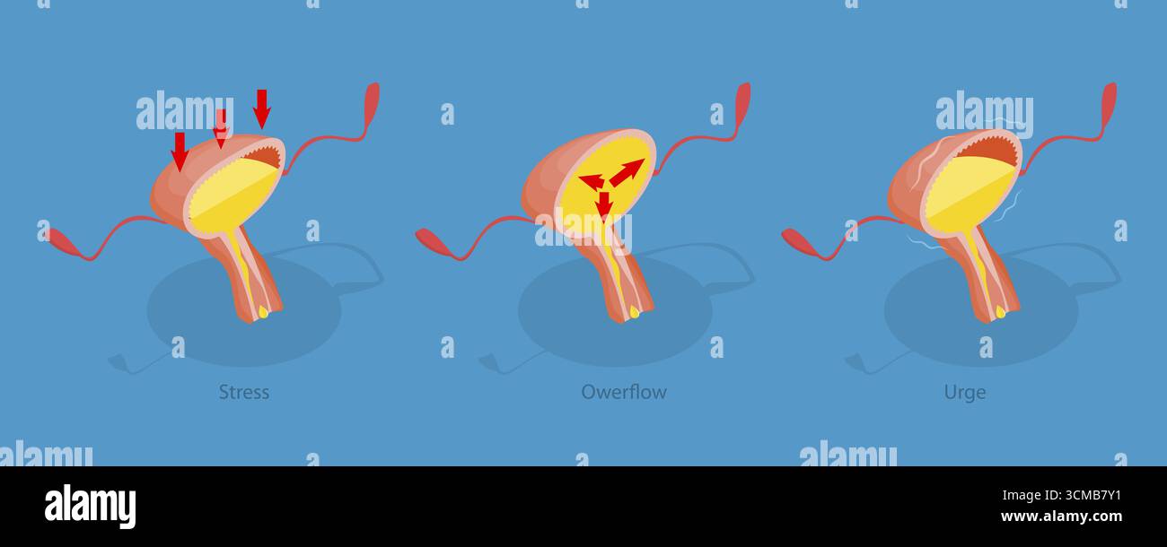 3D Isometrische flache Darstellung der Harninkontinenz, Diagramm mit verschiedenen Arten von Inkontinenzproblemen. Stress, Überlauf und Drang Stockfoto