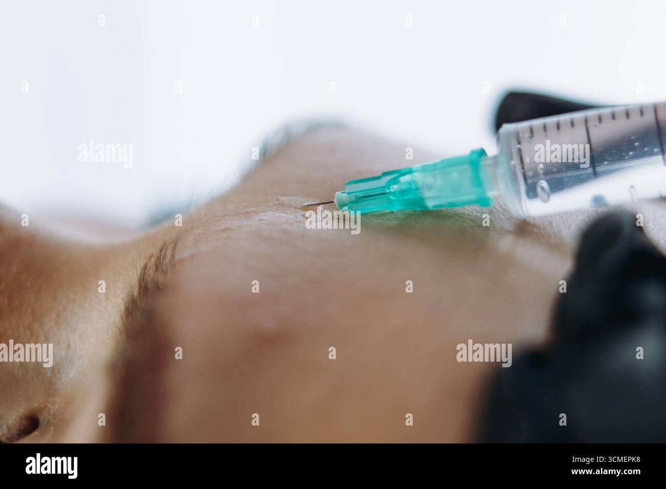 Nahaufnahme von professionellen Händen, die eine Verjüngungsinjektion in die Stirnfalte der Frau machen Stockfoto