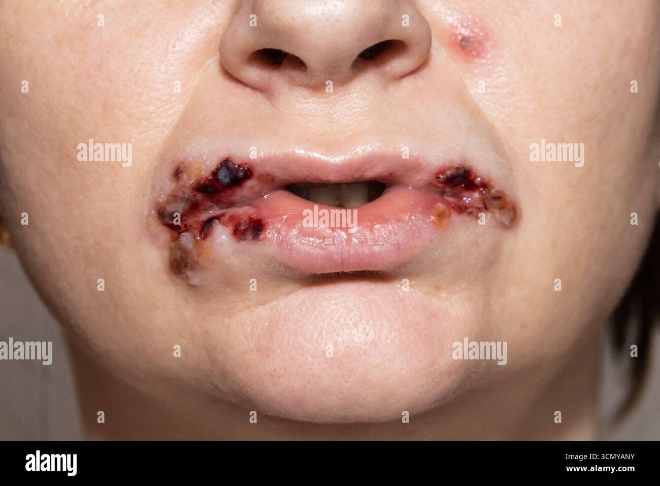 Infektion der Lippen. Riss im Mundwinkel, Wunden um den Mund, Wunde Lippen mit trockenem Blut im Gesicht der Frau. Stockfoto