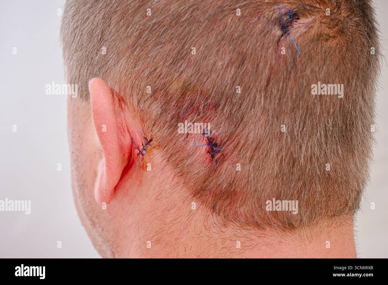 Die Kopfhaut des Mannes zeigt mehrere genähte Wunden in der Nähe des Ohres, was eine medizinische Behandlung darstellt. Stockfoto