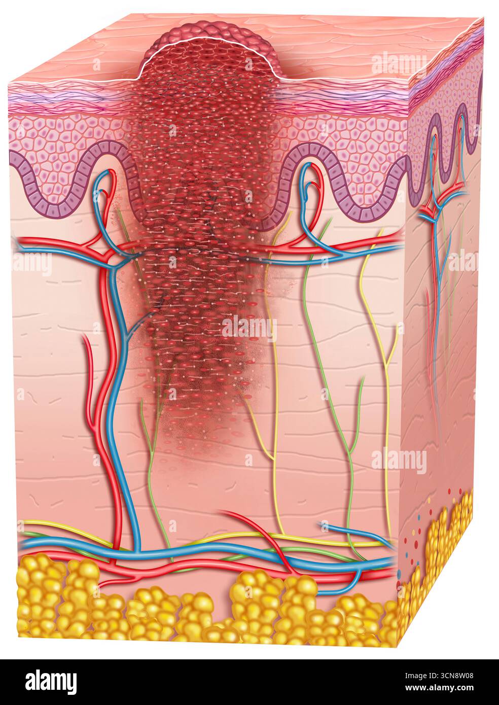 Illustration der Haut mit fortgeschrittenem Melanom. Das Melanom im Stadium IV ist gekennzeichnet durch die Ausbreitung von Krebszellen in entfernte Körperbereiche, jenseits von Venen, Arterien, Lymphknoten und anderen Organen, die Metastasen verursachen. Stockfoto
