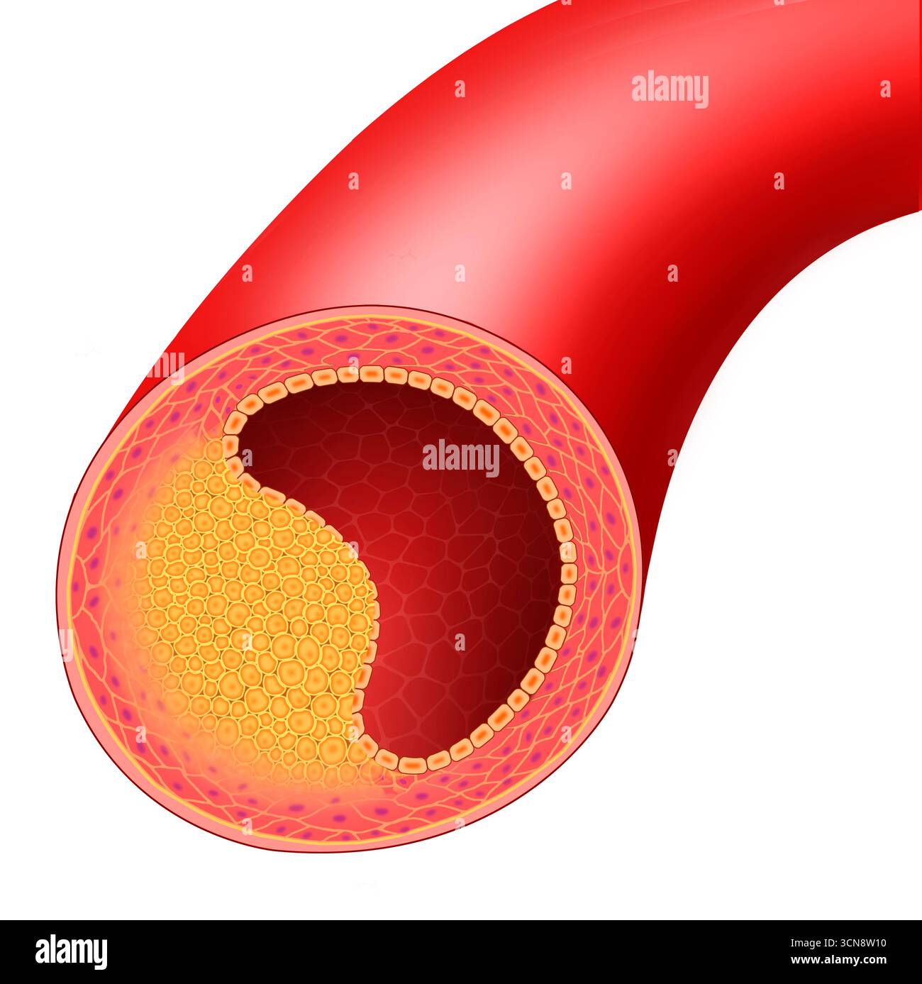 Illustration der fortgeschrittenen Arteriosklerose. In dieser Phase erleiden Arterien eine Plaquebildung an ihren Innenwänden aufgrund der umfangreichen Ansammlung von Plaque aus Lipiden und Zellen. Dadurch wird der Durchmesser der Blutgefäße drastisch reduziert. Stockfoto