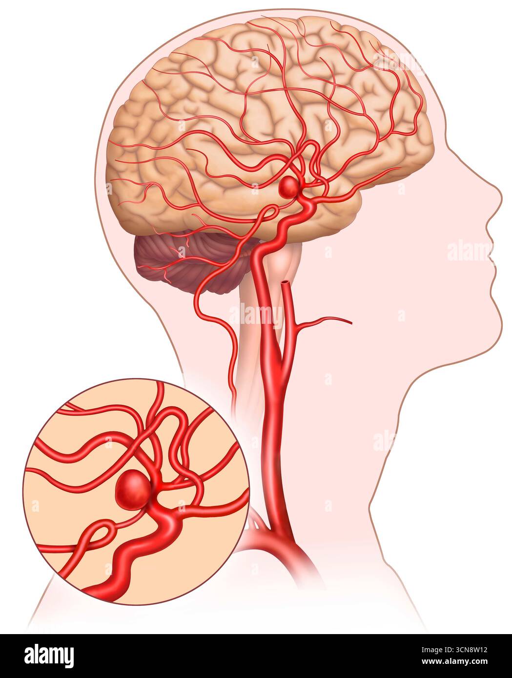 Abbildung eines menschlichen Kopfes mit einem zerebralen arteriellen Aneurysma und einer Nahaufnahme des Aneurysmas. Das Aneurysma ist vergrößert und die geschwächten Ausbuchtungen der Arterie sind zu sehen. Diese können sich mit Blut füllen und Rupturen verursachen, was lebensbedrohliche Blutungen verursachen kann. Stockfoto