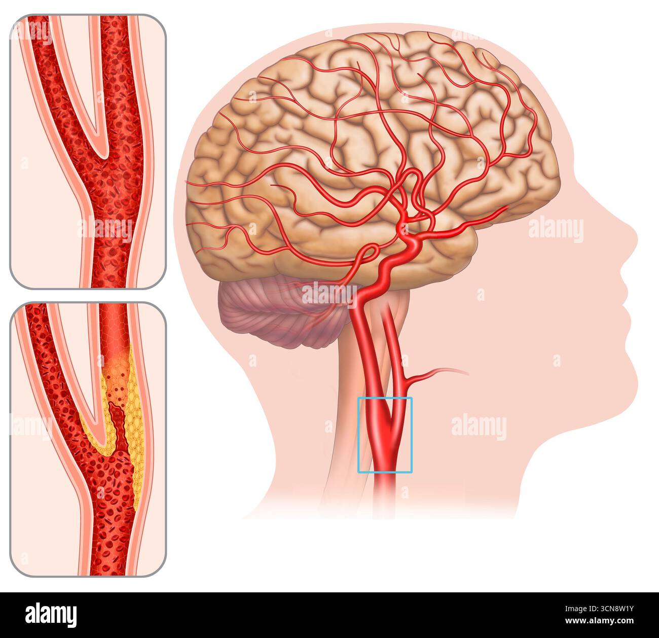 Illustration der Karotisstenose. Die anormale Verengung dieser Arterie, die das Gehirn mit Blut versorgt. Es wird normalerweise durch die Ansammlung von atherosklerotischer Plaque an den Arterienwänden verursacht und kann zu einer verminderten Blutzufuhr zum Gehirn führen und das Risiko eines Schlaganfalls erhöhen. Stockfoto