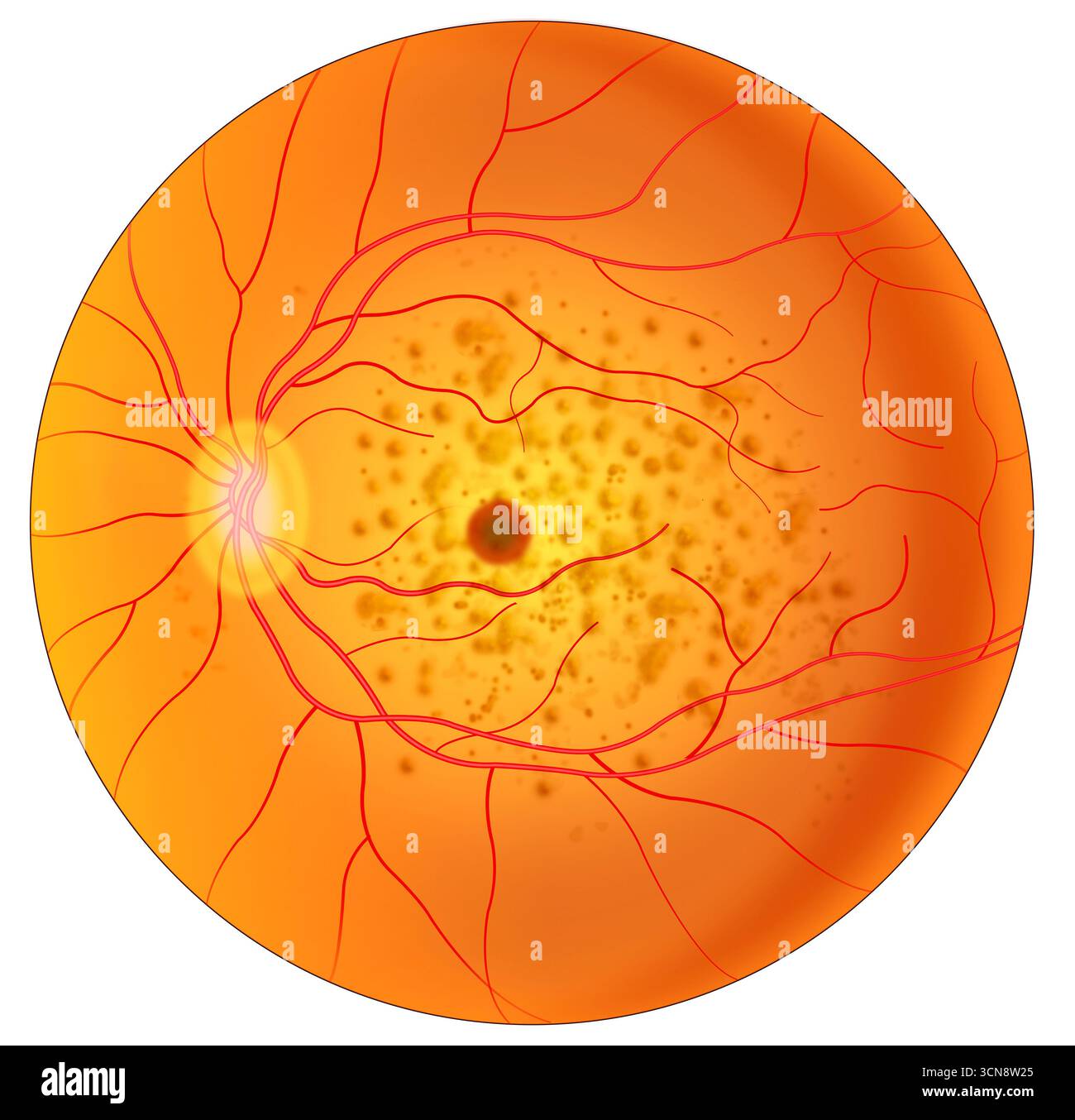 Illustration der trockenen altersbedingten Makuladegeneration (AMD), einer Augenkrankheit. Es handelt sich um eine Augenerkrankung, die langsam das zentrale Sehvermögen zerstört, den Teil des Auges, der das scharfe Frontalsehen steuert, wodurch es schwierig ist, feine Details zu lesen und zu sehen. Diese Krankheit tritt am häufigsten bei Menschen über 60 Jahren auf. Stockfoto