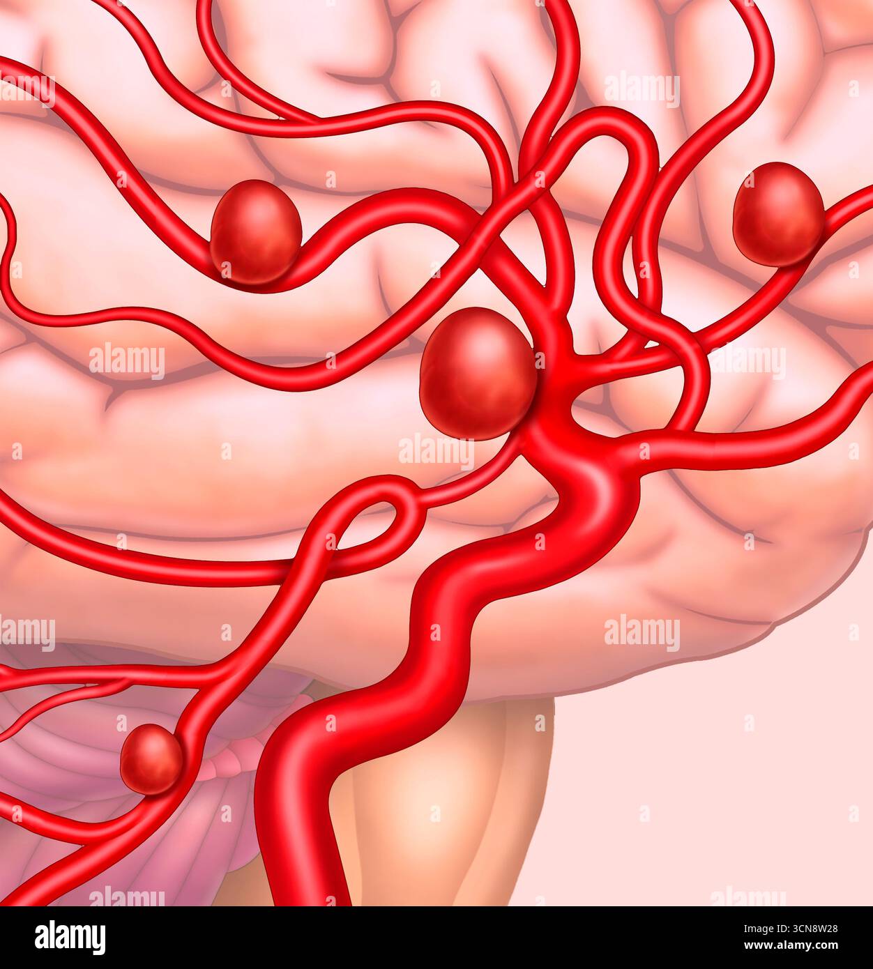 Abbildung eines zerebralen arteriellen Aneurysmas. Dies sind geschwächte Ausbuchtungen in den Arterien des Gehirns, die sich mit Blut füllen und Druck auf das umgebende Gewebe ausüben können. Sie reißen oft und verursachen schwere und lebensbedrohliche Blutungen. Stockfoto
