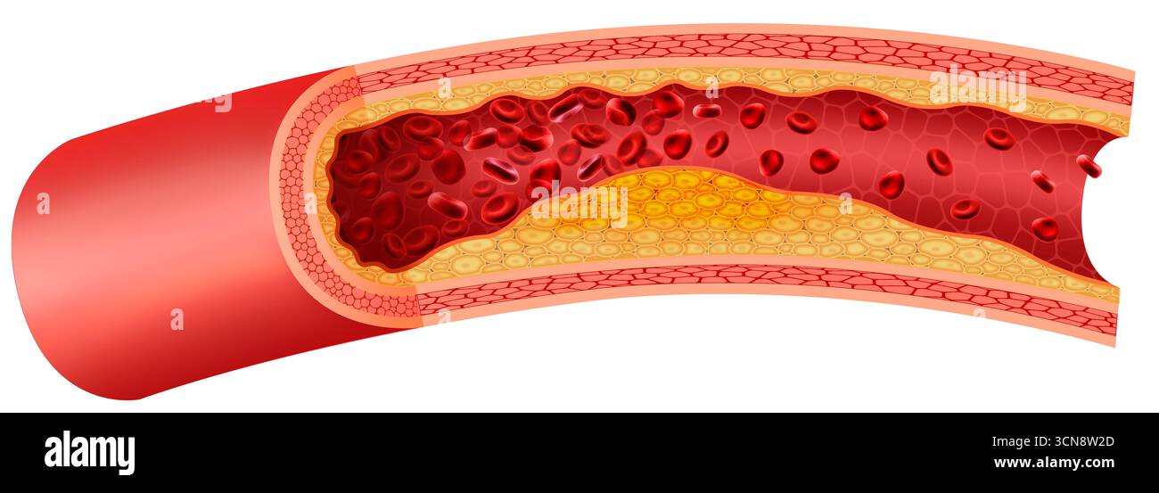 Illustration der Atherosklerose im fortgeschrittenen Stadium. In diesem Stadium erleben die Arterien eine signifikante Verengung aufgrund der Ansammlung von Plaques, die aus Lipiden und Cholesterin bestehen. Dieser Prozess reduziert drastisch den Durchmesser der Blutgefäße, beeinträchtigt den arteriellen Blutfluss und erhöht das Risiko für schwerwiegende kardiovaskuläre Ereignisse. Stockfoto